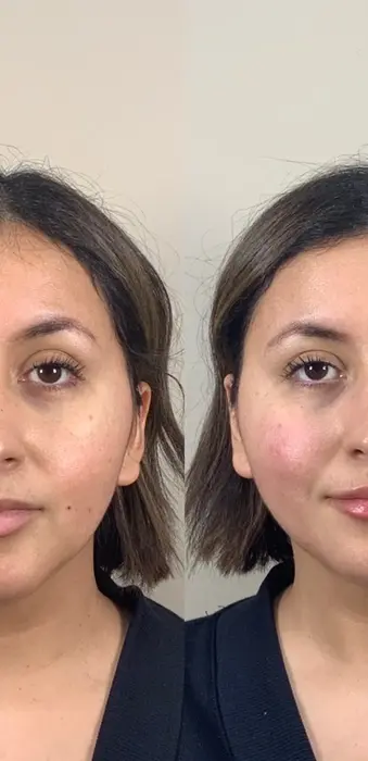 Before and after facial balancing treatment with cheek, chin, and lip filler enhancing facial proportions and definition.