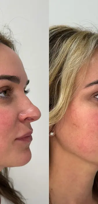 Lip filler before and after right angle showing enhanced lip projection, volume, and definition.