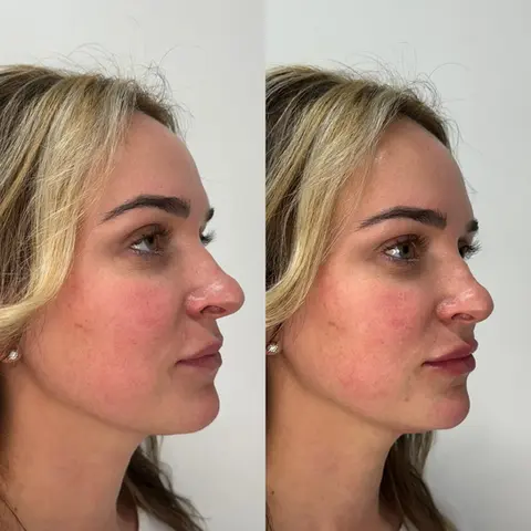 Lip filler before and after right angle showing enhanced lip projection, volume, and definition.