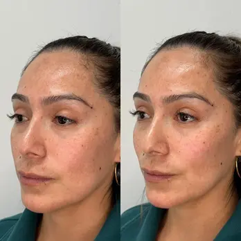 Midface filler before and after left angle showing enhanced cheek projection and contour.