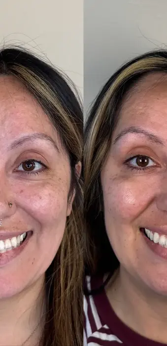 Before and after Botox for crow’s feet with improved smoothness around the eyes on a full face view.