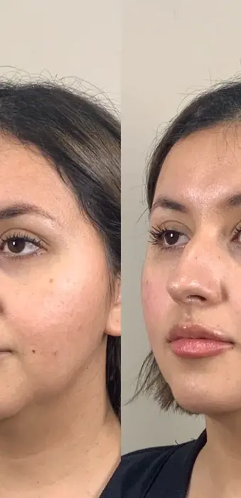 Facial balancing before and after with dermal fillers improving contour, volume, and symmetry.