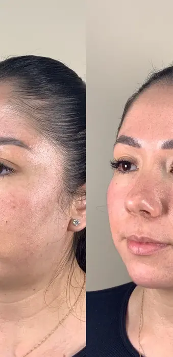 Facial balancing treatment results for cheeks and chin creating a more balanced and refined appearance.