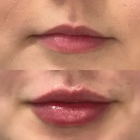 Lip filler before and after front view showing enhanced volume, symmetry, and natural-looking results.