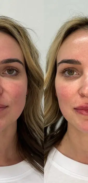 Before and after lip filler right front view with improved lip fullness and profile balance.