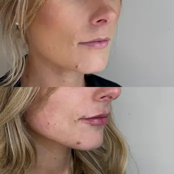 Before and after lip filler treatment showing natural-looking volume and improved lip symmetry.