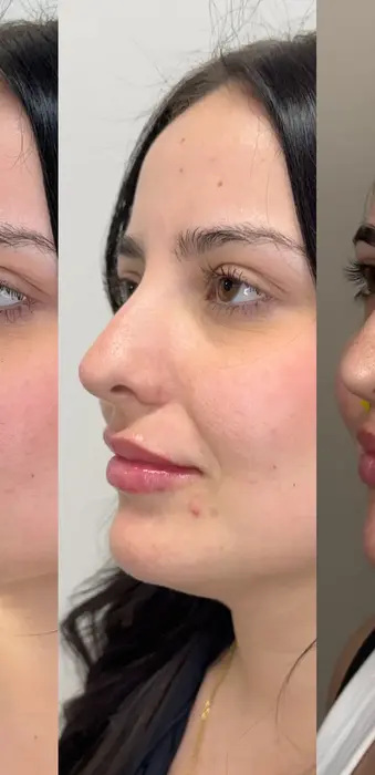 Lip filler before and after left side angle showing improved lip projection and contour.