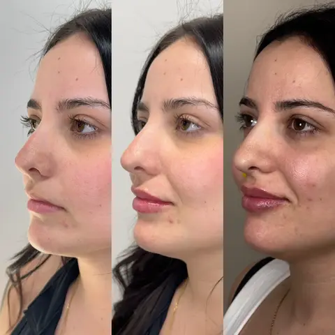 Lip filler before and after left side angle showing improved lip projection and contour.