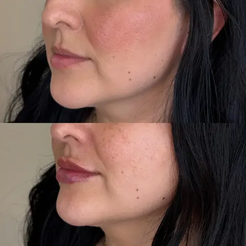 Left angle lip filler results showing better lip projection and balanced profile.