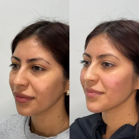 Before and after cheek and chin filler treatment showing improved facial contour and volume.