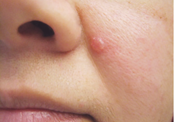 Can Skin Cancer Look Like a Pimple That Won't Go Away?
