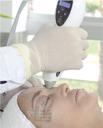 Thermage Párpados