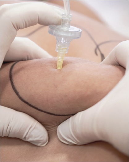 Carboxiterapia