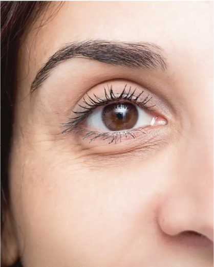Carboxiterapia Ojeras
