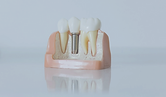 pexels-implantat-web_edited_edited.png