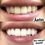 Miniatura: Blanqueamiento Dental -BLACK IS WHITE