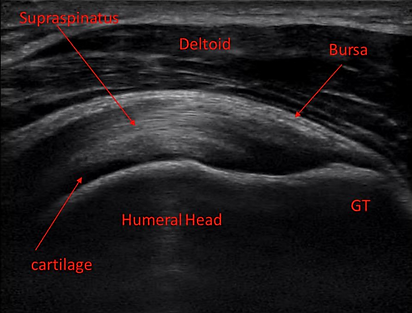 Diagnostic Ultrasound help us see in real time muscles, tendons and ligaments to identify the root cause of your pain.