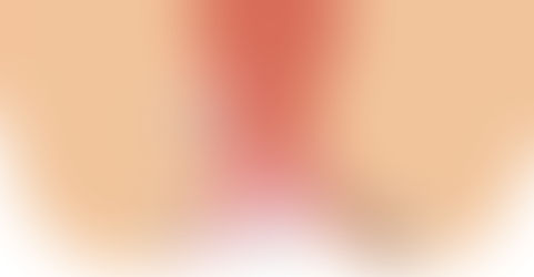 丹梔逍遙散加味治外痔驗案乙則