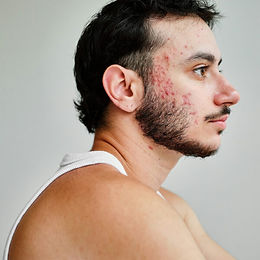 鬚瘡治療病案分享