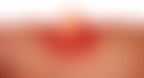 瘡瘍