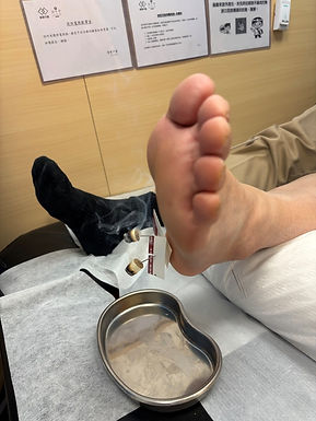 隨診隨緣（三）溫針灸治療足跟痛