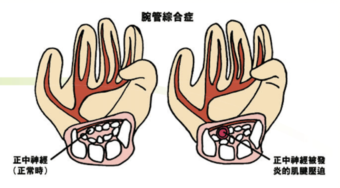 腕管綜合癥