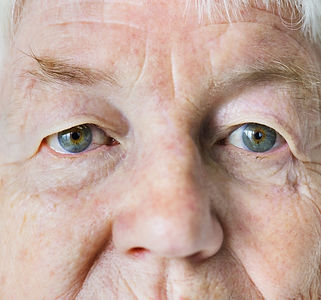 elderly-woman-candidate-Oculoplastic-Sur
