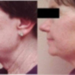 UltraSlim can help with a nonsurgical facelift by tightening the skin and making collagen