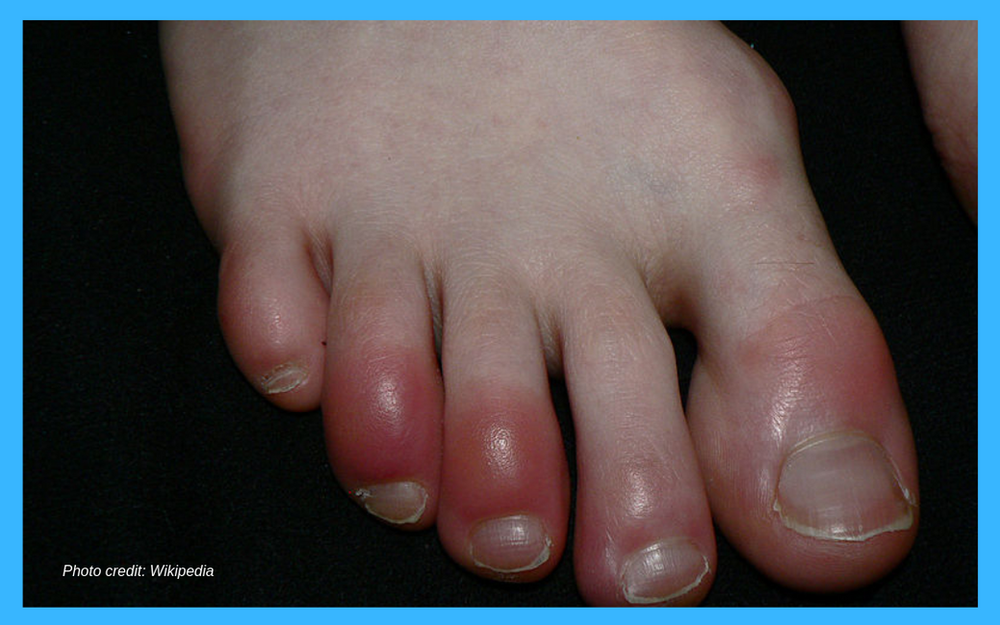 Chilblains