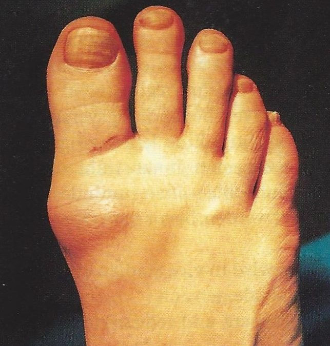 Stiff Big Toe (Hallux Rigidus)