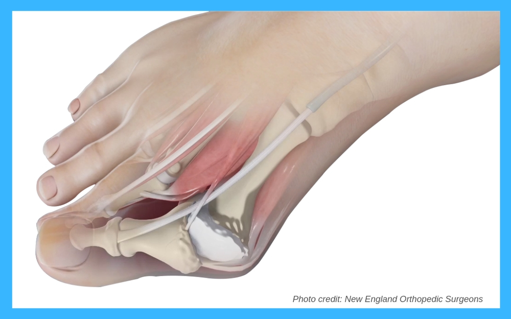 Bunion Removal Before and After