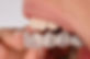 Orthodontie par aligneur