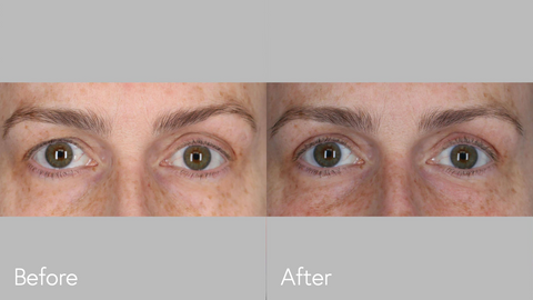 Blepharoplasty B&A