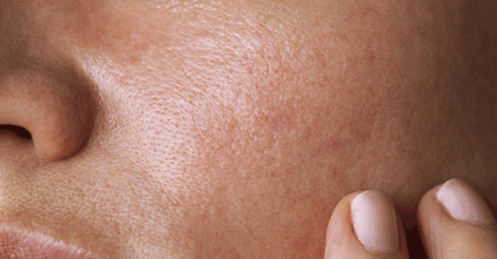 Dryskin_MetrinSkincare_resized-700x365.g