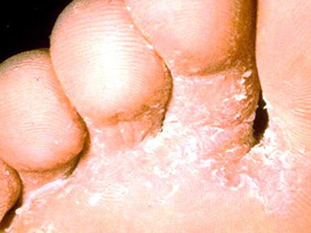 Athlete's Foot