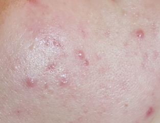 ACNE PUISTJES HUID HUIDTYPE BABOR SYNERGIE SKIN PCA SKIN MEDIK8 ALPHA-H OXYGENETIX THOCLOR