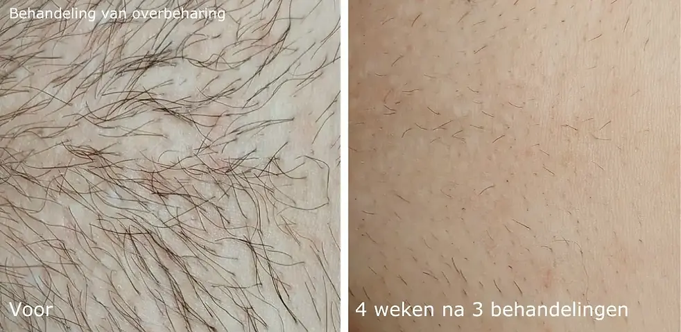 AD Overbeharing Voor en na 3 behandelingen laserontharing behandeling voor mannen medisch 