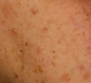 Zonschade in de spotlight Huidstudio Leek Marisa Dost Medisch Schoonheidsspecialist Dermat