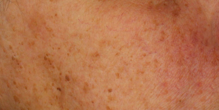 Zonschade in de spotlight Huidstudio Leek Marisa Dost Medisch Schoonheidsspecialist Dermatologie 2.jpg