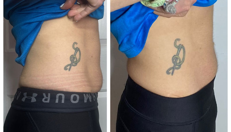 Cryotherapy T Shock Before & AfterBefore & After