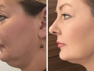 High_Intensity_Focused_Ultrasound_face_lift_before_and_after-1296x728-gallery-1-1024x575.w