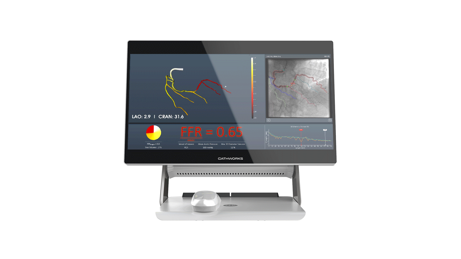 Data Scientists from Vision Elements Accelerate Research for a Game Changing Medical Device