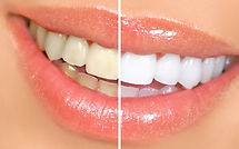 tipos-de-blanqueamiento-dental1-1080x675.jpg