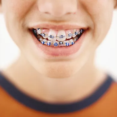 braces.webp