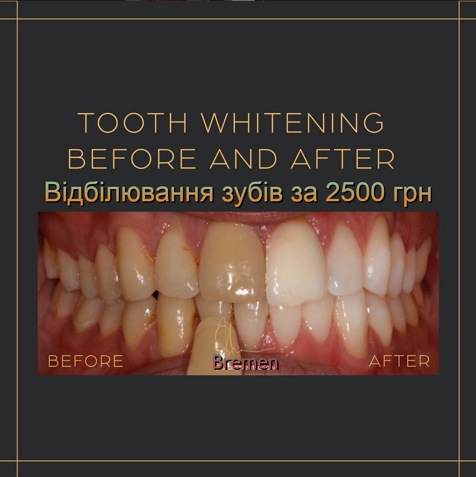 teeth whitening 2