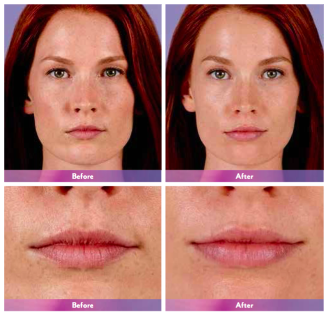 THINNING LIPS remedyhealth
