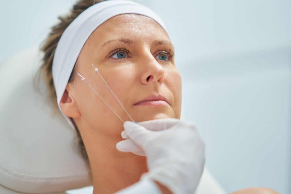 Client receiving a threadlift procedure, focusing on lifting sagging facial skin.