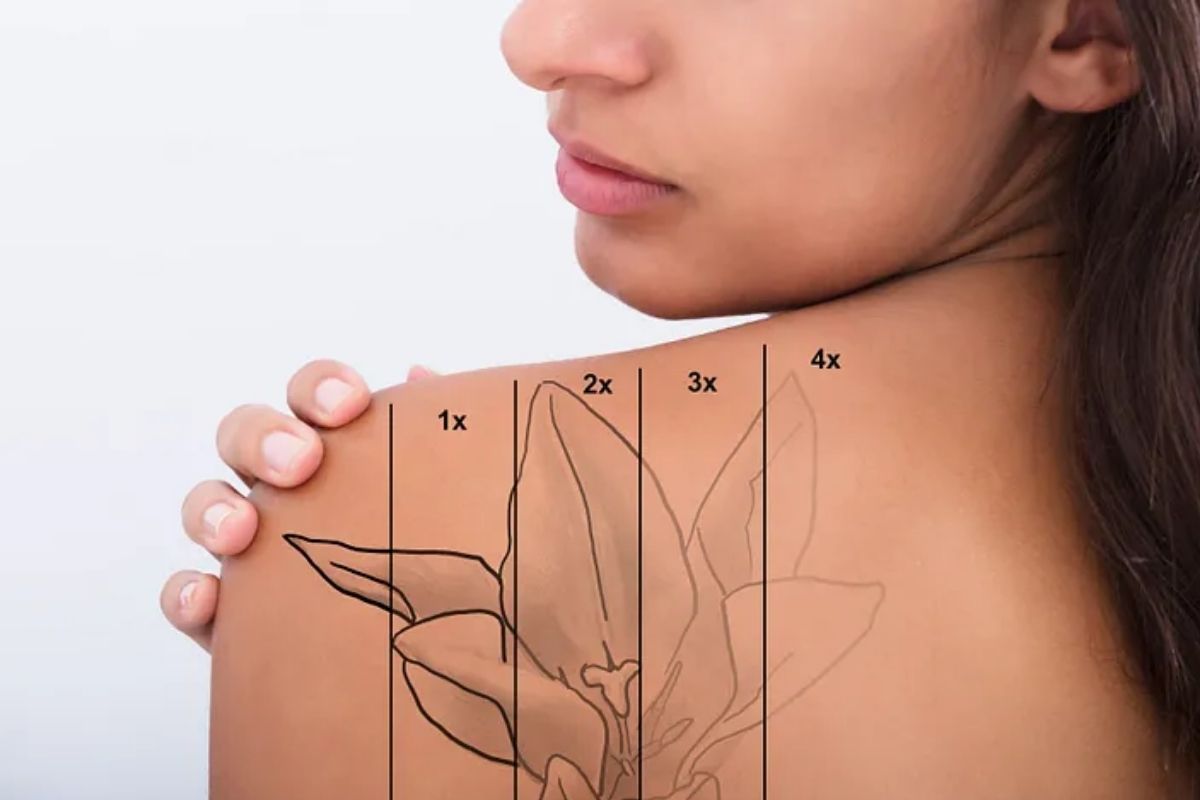 Visible fading after multiple laser tattoo removal sessions.