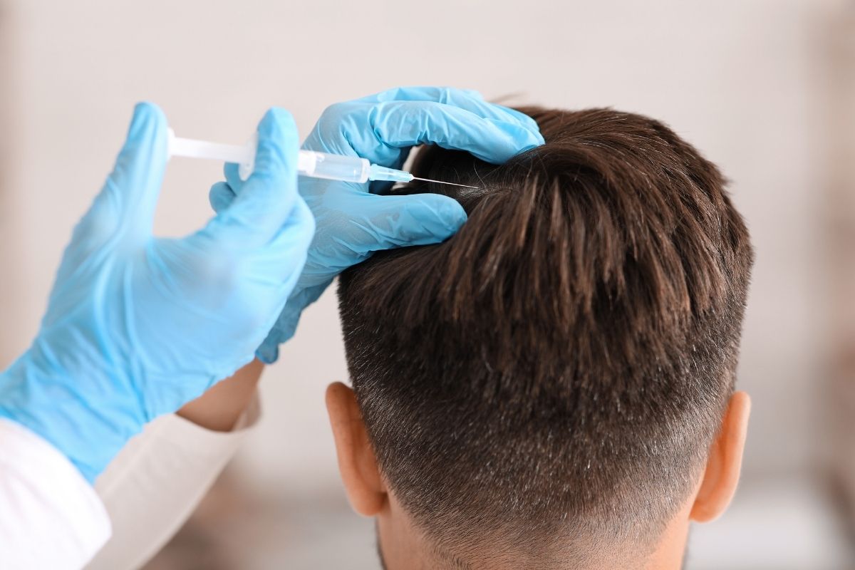 Patient undergoing PRP therapy for hair regrowth in Noida.