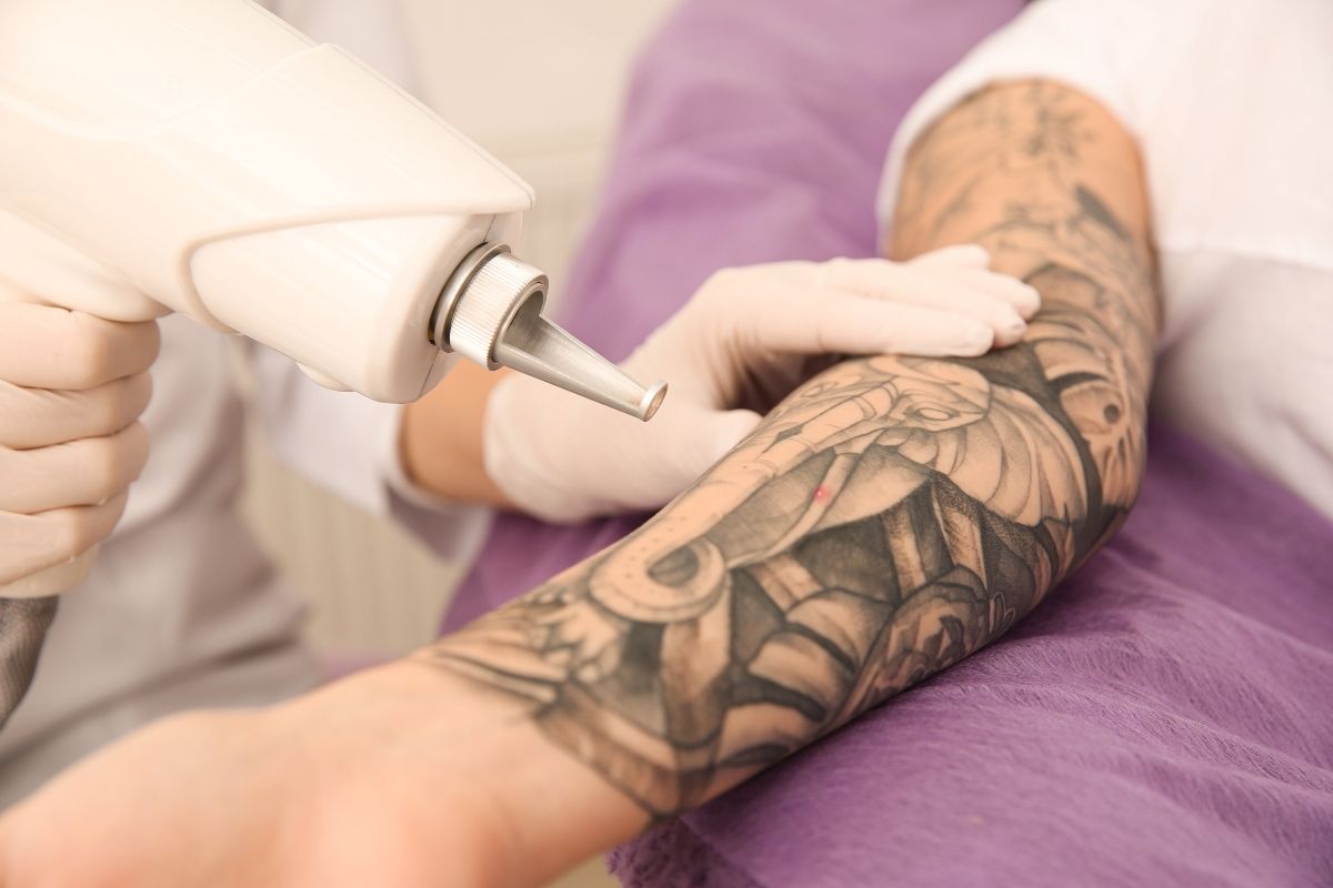 Laser Tattoo Removal | Skin104